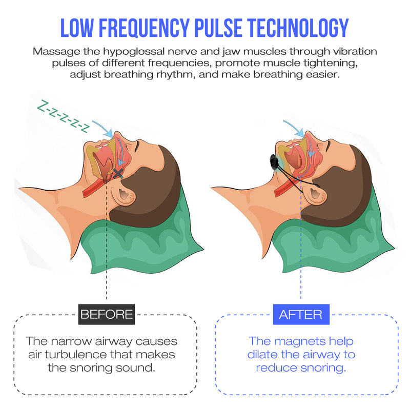 Smart Anti Snoring Device Portable EMS Pulse Noise Reduction Snore Stopper Health Care